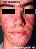 Melasma: Manchas Escuras na Pele do Rosto acne IV Melasma: Manchas Escuras na Pele do Rosto