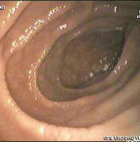 DOENÇA CELÍACA: Sintomas, Diagnóstico e Tratamento doença celíaca endoscopia DOENÇA CELÍACA: Sintomas, Diagnóstico e Tratamento