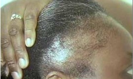 Queda de cabelo: tipos de alopecia – parte ii