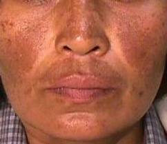 Melasma: manchas escuras na pele do rosto