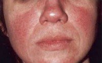 RosÁcea: vermelhidão no rosto – causas e tratamento