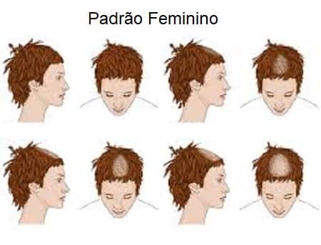Queda de cabelo: tipos de alopecia – parte i
