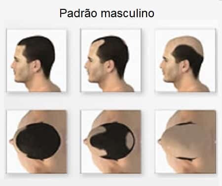 Queda de cabelo: tipos de alopecia – parte i